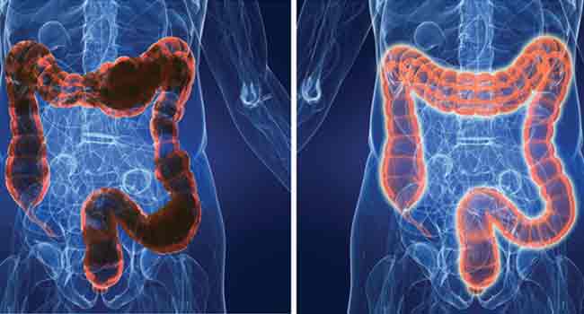 Image of the large intestine before and after Colonic Hydrotherapy